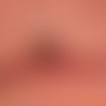 Cornu cutaneum: close-up, with a fresh crust of blood on the side, which was formed after a carel...