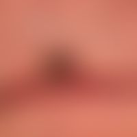 Cornu cutaneum: close-up, with a fresh crust of blood on the side, which was formed after a carel...