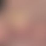 Cornu cutaneum: existing for several years, the "skin horn" has fallen off again and again, then ...