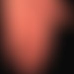 Crest syndrome, multiple telangiectasias of the palms and fingers. Only moderately pronounced scl...