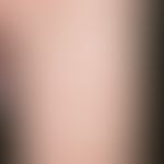 Culicosis. disseminated, irregularly configured, intensely itchy, intensely red, urticarial papul...