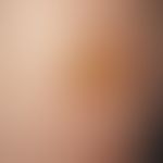 Culicosis bullosa. Ungewöhnlich große Blasenbildungen nach Mückenstich am Unterschenkel einer 18-...