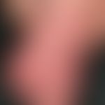 Cutis marmorata teleangiectatica congenita (localisata), symptomless vascular malformation with r...