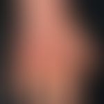 Cutis marmorata teleangiectatica congenita (localisata) during the course of 2 years after the fi...
