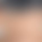 Cutis rhomboidalis nuchae. Grobmaschigem wulstige&nbsp;Faltenbildung im Nacken bei massiver aktin...