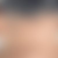 Cutis rhomboidalis nuchae. coarse-meshed, bulging wrinkles in the neck with massive actinic elast...