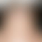 Cutis rhomboidalis nuchae. Überlappende&nbsp;Faltenbildung im Nacken bei massiver Elastosis actin...
