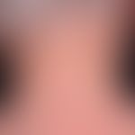 Cutis rhomboidalis nuchae:&nbsp;gefelderte&nbsp;Faltungen der Haut&nbsp;bei massiver Elastosis ac...