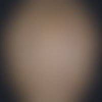 Cutis verticis gyrata: cerebriform (gyriform), symmetrical, asymptomatic folds and furrows of the...