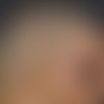 Cutis verticis gyrata: Lateral profile of the capillitium of a 26-year-old patient (bodybuilder),...