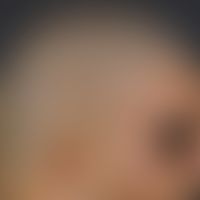 Cutis verticis gyrata: Lateral profile of the capillitium of a 26-year-old patient (bodybuilder),...