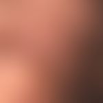Cutis verticis gyrata: cerebriform thickenings, furrows and folds of the capillitium which have e...