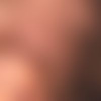 Cutis verticis gyrata: cerebriform thickenings, furrows and folds of the capillitium which have e...