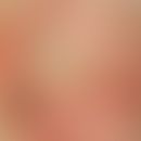 Dekubitus. Grad IV. Zentrale Ulzeration mit schmierigen Belägen auf flächigem Erythem, links hämo...