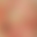 Decubitus, grade IV, central ulceration with a greasy coating on an extensive erythema, on the le...