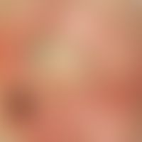 Decubitus, grade IV, central ulceration with a greasy coating on an extensive erythema, on the le...