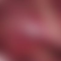 Chronic dynamic (changeable course), painless, superficial ulcer with a whitish margin caused by ...