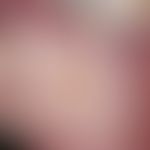 Decubitus. acute, 1.5 cm large, slightly pressure-dolent, sharply defined, yellowish depression (...