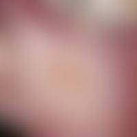 Decubitus. acute, 1.5 cm large, slightly pressure-dolent, sharply defined, yellowish depression (...