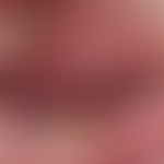 Decubitus. chronic stationary, approx. 2.5 cm long, flat, extremely painful ulcer at the transiti...