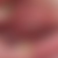 Decubitus. chronic stationary, approx. 2.5 cm long, flat, extremely painful ulcer at the transiti...