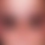 Demodex-Follikulitis: Verteilungsmuster der typischen, follikulären, entzündlichen Knötchen. Befa...