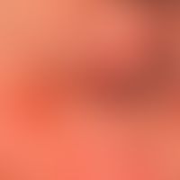 Demodex-Follikulitis: Bild der "periokulären Dermatitis". Keine vorbekannte Behandlung mit Lokalk...