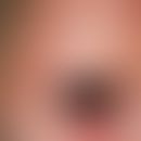 Dennie-Morgan-Infraorbitalfalte. Doppelte Lidfalte am Unterlid sowie Rarefizierung der lateralen ...