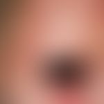 Dennie-Morgan infraorbital fold: Double eyelid crease on the lower lid as well as a rarefication ...