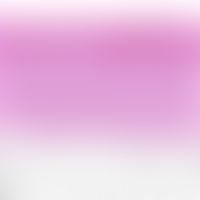 Dermatitis. diffuse dermatitis (example: sweet syndrome; acrodermatitis chronica atrophicans Herx...