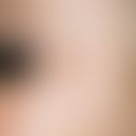 Lymphadenosis cutis benigna: brownish, bulging elastic, painless, moderately sharply defined lump...