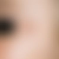 Lymphadenosis cutis benigna: bräunlicher, prall elastischer, schmerzloser, mäßig scharf begrenzte...