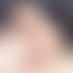 Lymphadenosis cutis benigna: soft, reddish-livid, blurred reddish-brownish lump at the edge of th...