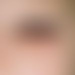 Lymphadenosis cutis benigna, tumor encompassing the entire lower eyelid, tightly elastic, since 4...