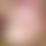 Lymphadenosis cutis benigna. symptomless, solitary, soft, brown-red, hemispherically bulging nodu...