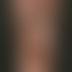 Metastasis: Multiple, differently sized, partly reddish, partly darkly pigmented smooth nodules o...