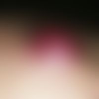 Metastasis: Chronically active, rapidly growing, hemispherically protruding, well-defined to the ...