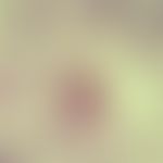 Amöbiasis. Amöben-Leberabszess. Der Trophozoit phagozytierte Erythrozyten (Magnaform) als Hinweis...