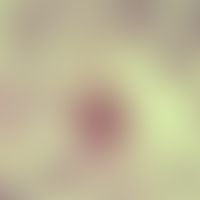Amöbiasis. Amöben-Leberabszess. Der Trophozoit phagozytierte Erythrozyten (Magnaform) als Hinweis...