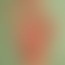 Anticonvulsant hypersensitivity syndrome: Palmar individual erythema with pustular formation in t...