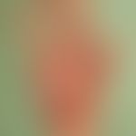 Antikonvulsiva-Hypersensitivitäts-Syndrom. Livides Palmar-Erythem mit Pustelbildung im Bereich de...