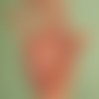 Antikonvulsiva-Hypersensitivitäts-Syndrom. Livides Palmar-Erythem mit Pustelbildung im Bereich de...