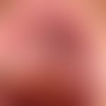 Leukoplakie. Sog. Leukokeratosis nicotinica palati.

