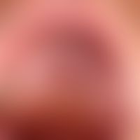 Leukoplakia. Suction. Leukokeratosis nicotinica palati.
