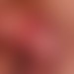Leukoplakie der Glans mit&nbsp;begleitender Balonoposthititis und beginnender Umwandlung in ein P...