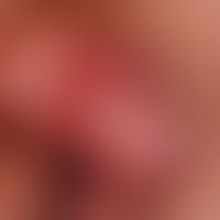 Leukoplakie der Glans mit&nbsp;begleitender Balonoposthititis und beginnender Umwandlung in ein P...