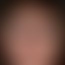 Lipoatrophie. Symmetrische Hautatrophie des Gesichts bei einer 51-jährigen Patientin mit progress...