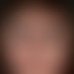 Lipoatrophie. Symmetrische Hautatrophie des Gesichts bei einer 51-jährigen Patientin mit progress...