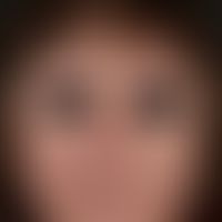 Lipoatrophy: Symmetrical skin atrophy of the face in a 51-year-old female patient with progressiv...