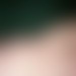 Lipoatrophie:&nbsp;typische "BH-Träger"-Lipoatrophie. Diese bandförmige Lipoatrophie entsteht dur...